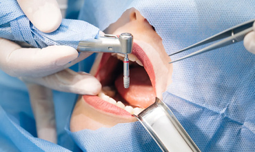 Implant Tedavisi Ardahan Okan Ok